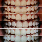 T9 Sensitive + Extra Set of Whitening Trays